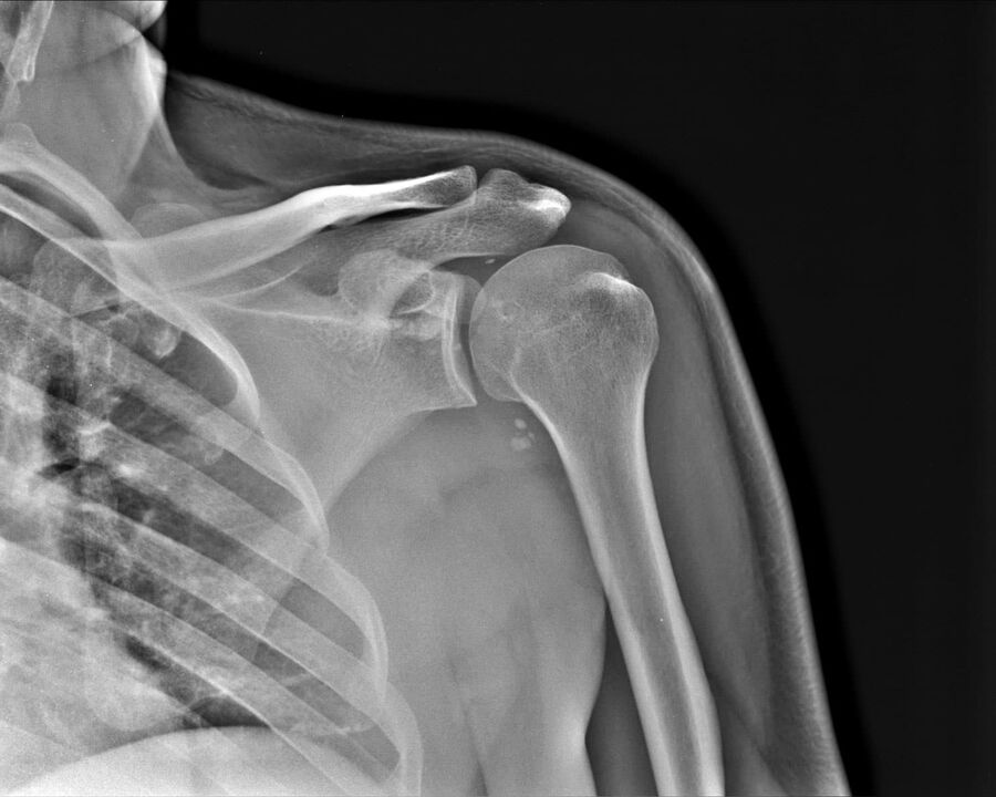 Radiography of arthrosis of the 2nd degree of severity of the shoulder joint