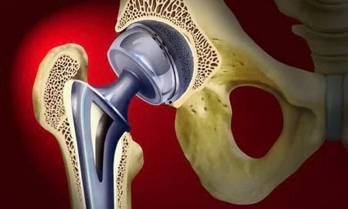 hip joint replacement for osteoarthritis