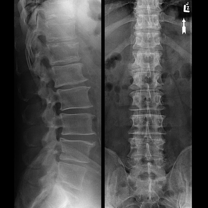 X-ray of the thoracic region, which shows a narrowing of the gap between the vertebrae along the spine from the bottom to the top
