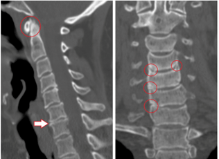 Computed tomography shows damaged vertebrae and heterogeneous-height discs due to thoracic osteochondrosis