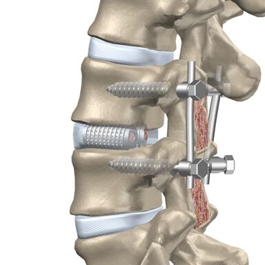 Replacing a destroyed thoracic spine disc with an artificial implant