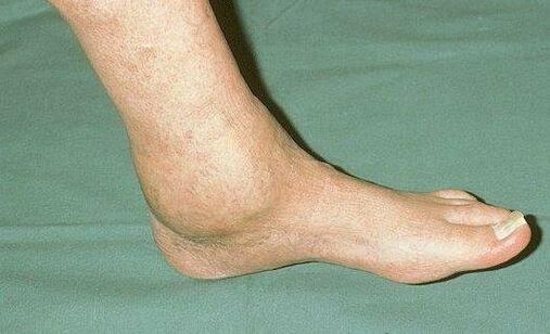 ankle swelling with arthrosis