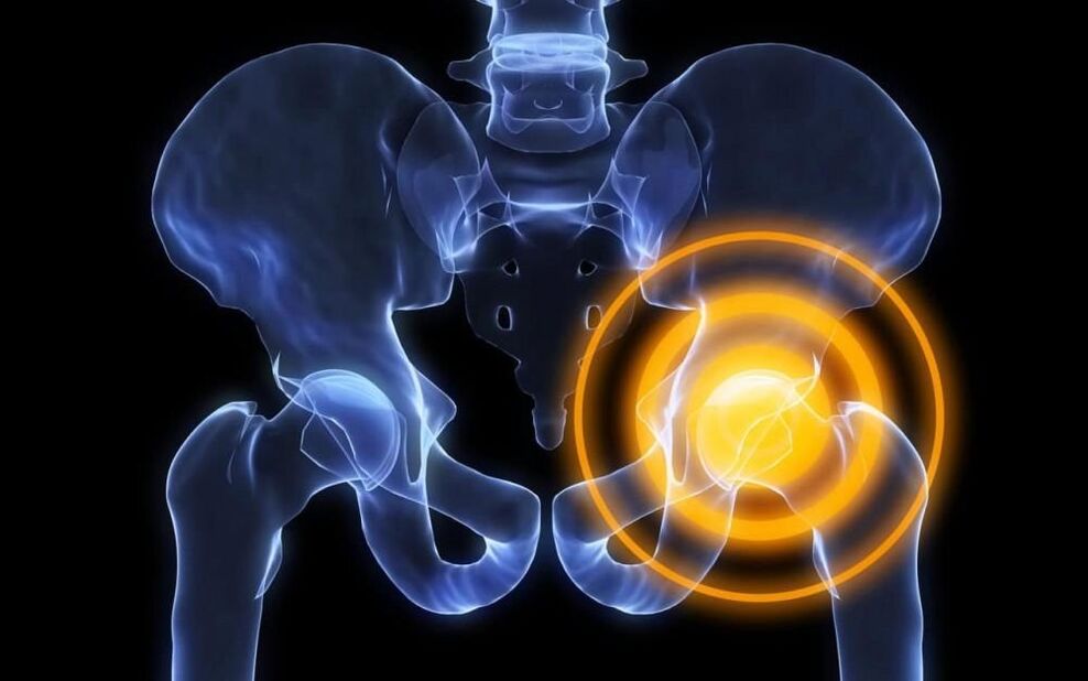 hip joint pain image 2