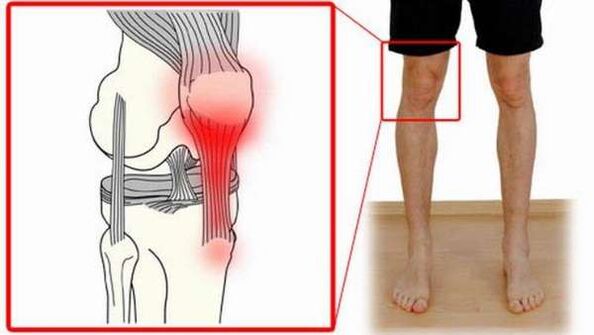 joint injury in osteoarthritis of the shoulder