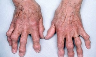 how to distinguish arthritis from fingers from arthrosis