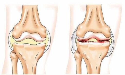 healthy knee joint and affected by osteoarthritis