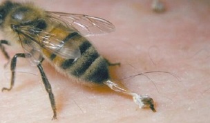 treatment of hip arthrosis by bees