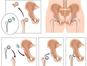 endoprostheses for arthrosis of the hip joint
