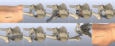 hip osteoarthritis treatment methods